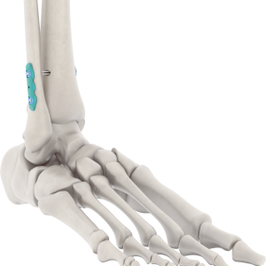 SISTEMA FIJACION FLEXIBLE 1